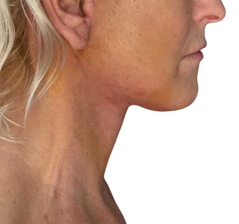Deep Plane facelift po zákroku